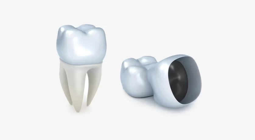 What Should Patients in Los Angeles Know About Porcelain Crowns?